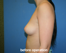 plastic-surgery-breast-augmentation